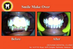 smile make over before and after images