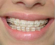 orthodontics11